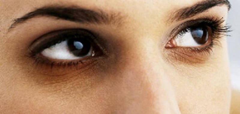 الهالات السوداء .. أسبابها، وعلاجاتها الطبيعية والطبية للتخلص منها